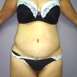 abdominoplasty-after